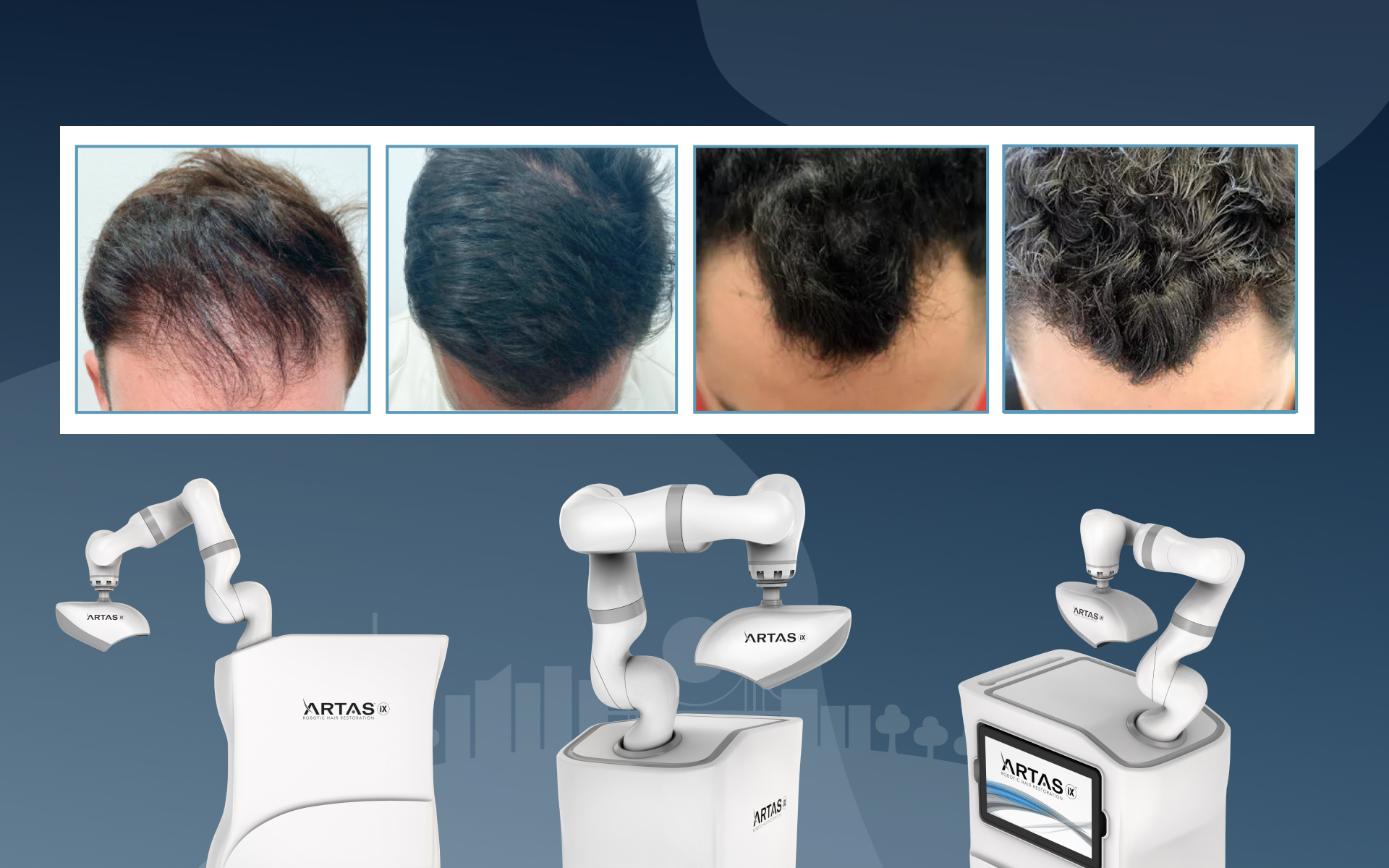 A Comprehensive Guide to Robotic Hair Transplants